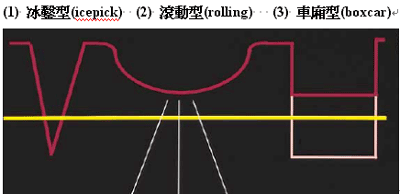 治療凹陷型痘疤的新選擇∼皮下刮除法與鑽孔切除法！_圖1