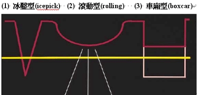 治療凹陷型痘疤的新選擇∼皮下刮除法與鑽孔切除法！