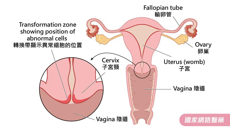 子宮頸癌預防與治療