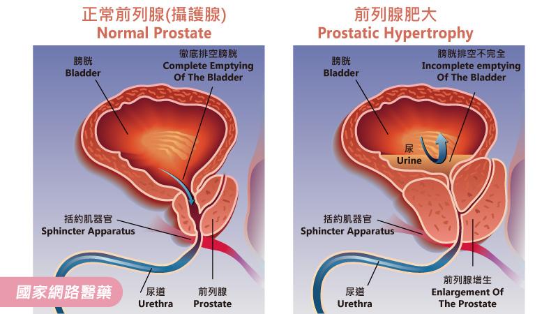 認識 男性攝護腺肥大 健康 Kingnet國家網路醫藥 Second Opinion