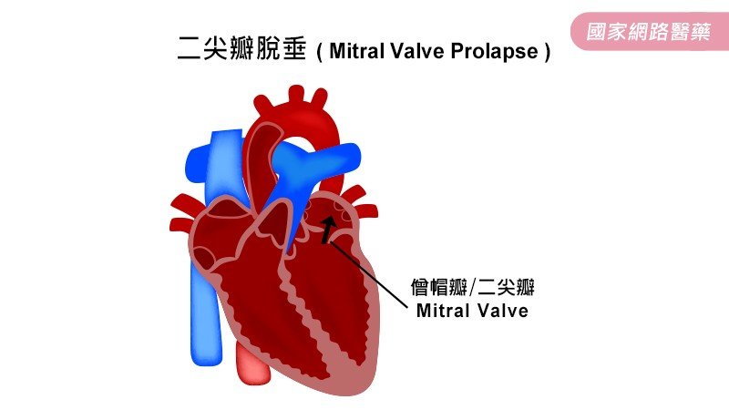 關於 二尖瓣脫垂 您知多少 Kingnet 國家網路醫藥 Second Opinion