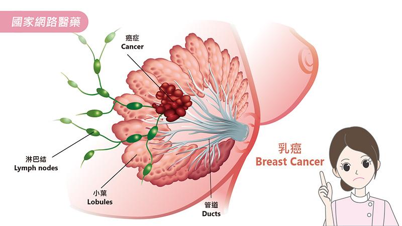 2017 年最新乳癌篩檢指南