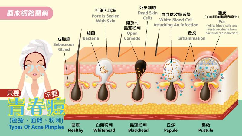 中藥平衡女性荷爾蒙，解決痘痘、月經不調困擾