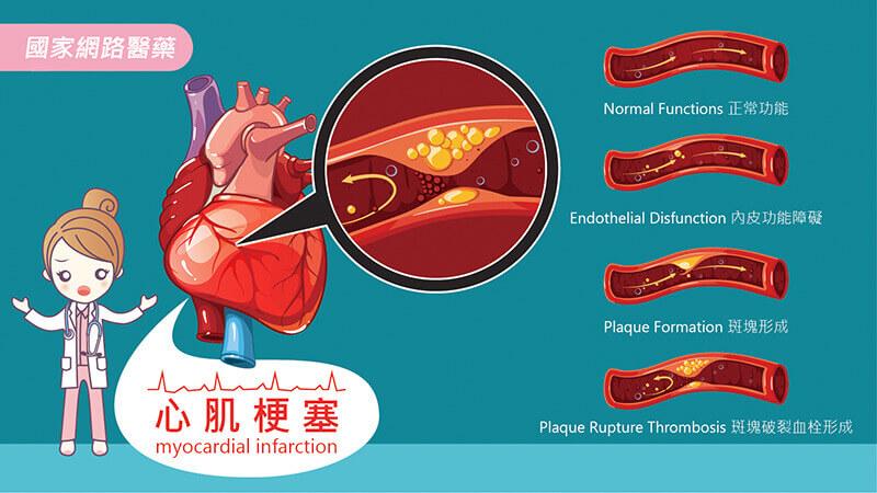 急性心肌梗塞：6種前兆莫輕忽