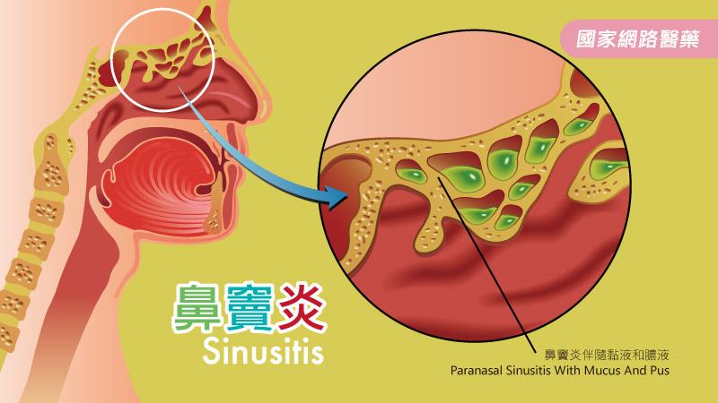 鼻瘜肉生生不息好困擾！鼻竇炎需適時治療