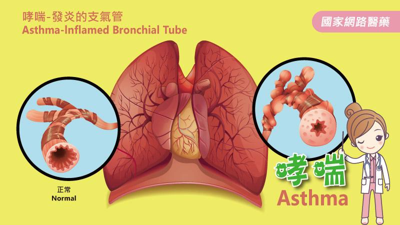 微生物 (Microbes)和氣喘 (Asthma)