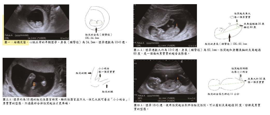 超音波看胎兒性別的真相 王培中 Kingnet國家網路醫藥 Second Opinion