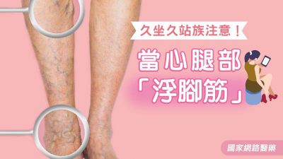 久坐久站族注意 當心腿部「浮腳筋」