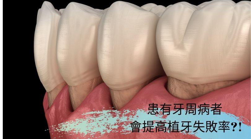 患有牙周病者  會提高植牙失敗率?!