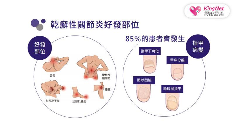 為乾癬性關節炎的活動解「封」！口服標靶藥物通過健保給付