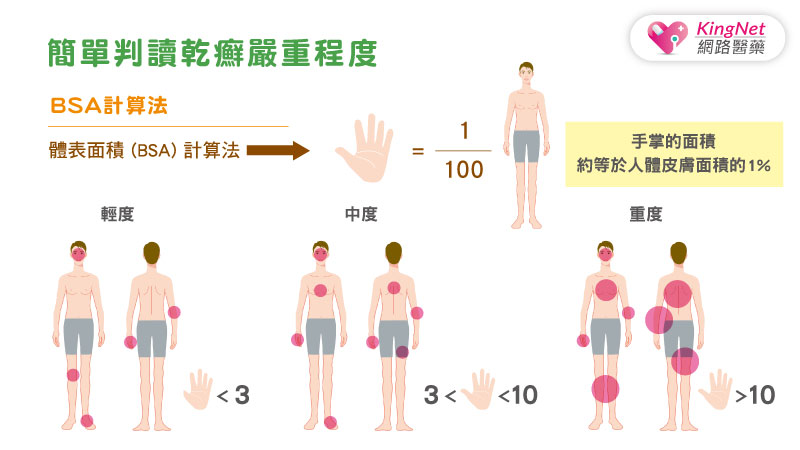 心臟病、腦中風、憂鬱症、關節炎……乾癬不只是皮膚病，竟是導致35種疾病的健康未爆彈！