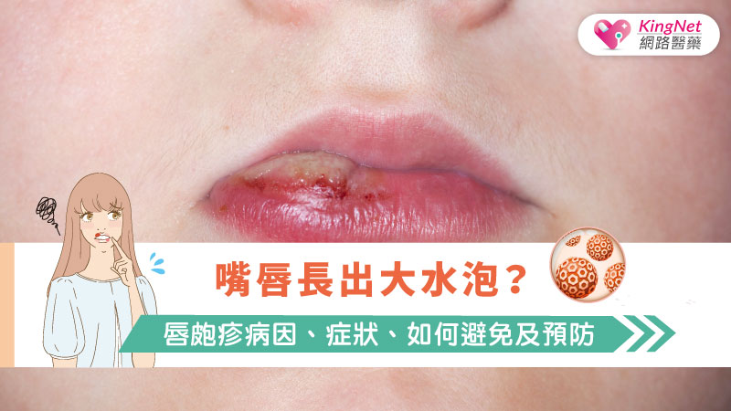 嘴唇長出大水泡？唇皰疹病因、症狀、如何避免及預防_圖1