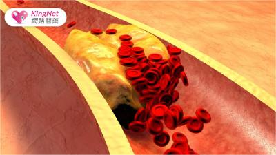 瘦子也會有膽固醇過高的問題！你對膽固醇認識有多少？